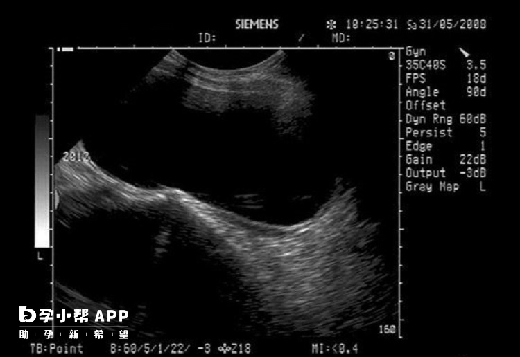阴道四维彩超下的始基子宫影像