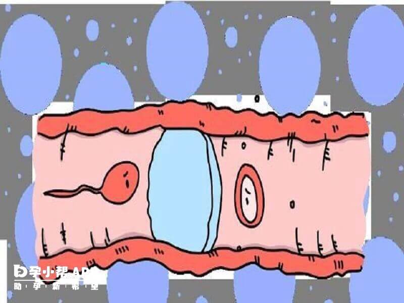 输卵管堵塞严重无法自然受孕