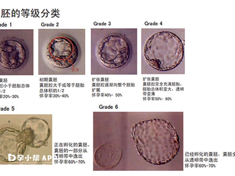 第五天（D5）囊胚质量评级