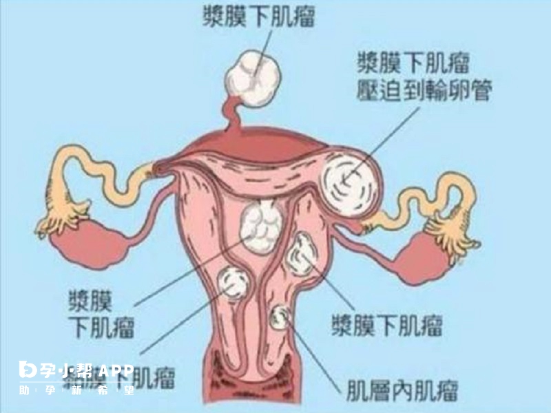 根据子宫肌瘤的状况进行治疗