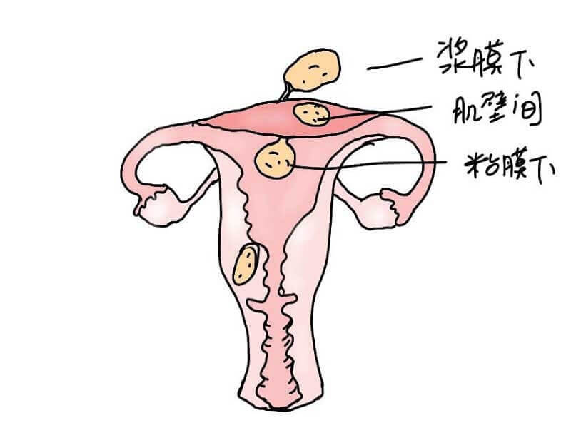 试管前治疗子宫肌瘤怀孕率更大