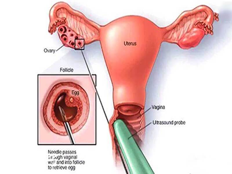格鲁吉亚试管婴儿流程抽吸卵泡液