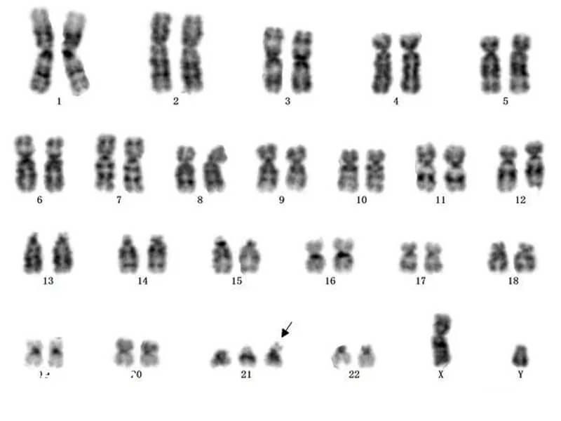 染色体异常会导致胎停育
