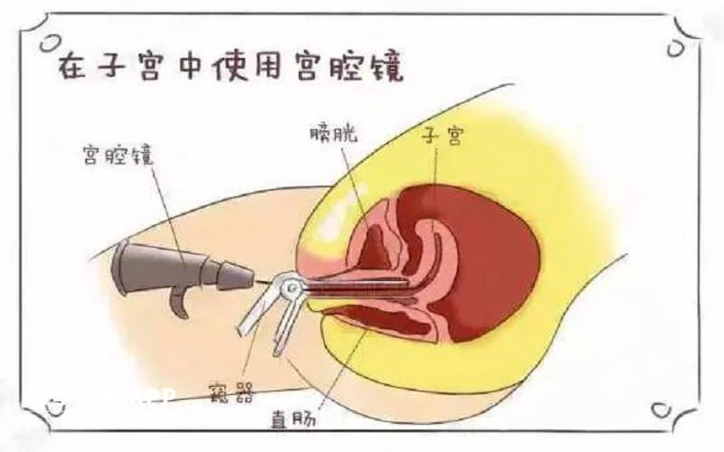 宫腔镜检查的危害