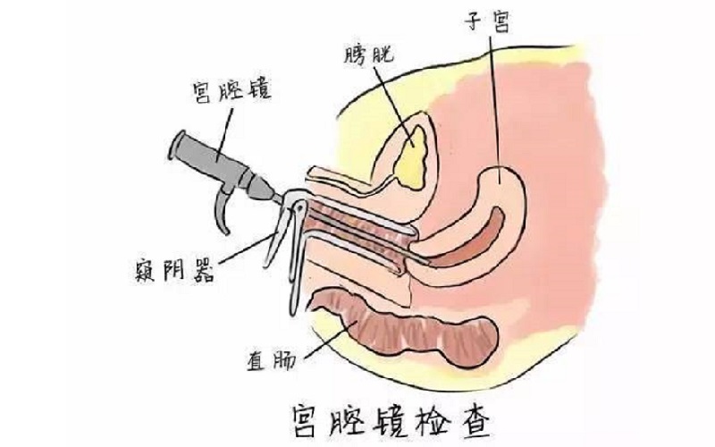 宫腔镜检查的步骤