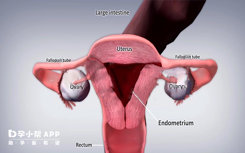子宫内膜异位症