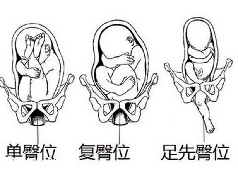 臀位和生男生女还有关系