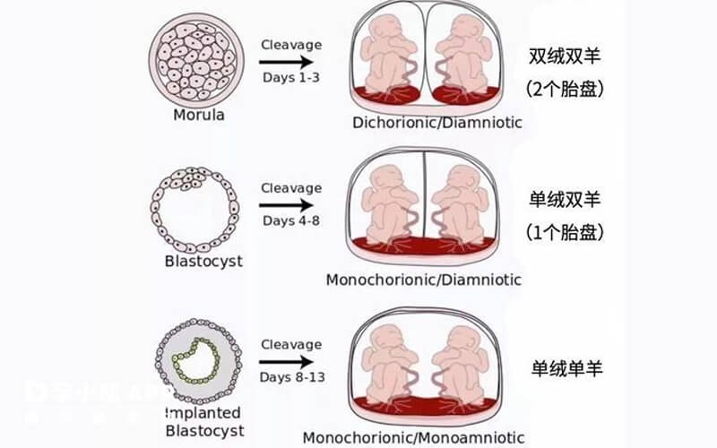 双胎妊娠的类型