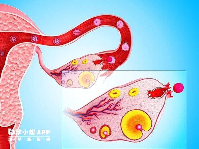 卵巢病变会导致无卵泡
