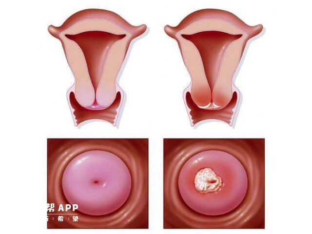 宫颈病变切除
