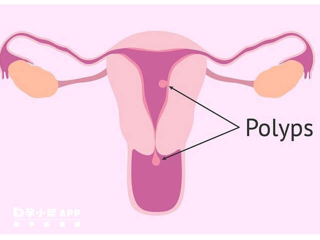 子宫息肉会影响怀孕