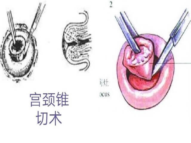 锥切手术和割子宫适应人群不同