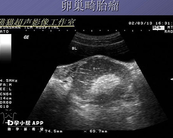 卵巢畸胎瘤检查单