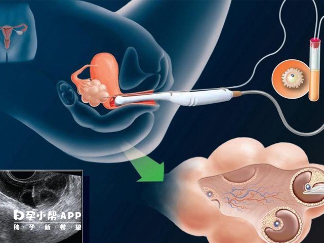 取卵手术具体过程