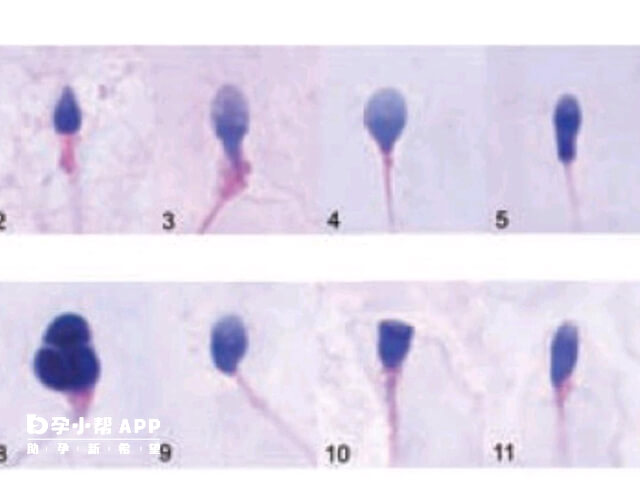 精子头部畸形形态