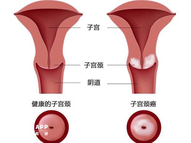 子宫颈小可能是先天造成的