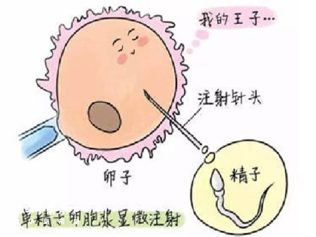 二代试管婴儿技术