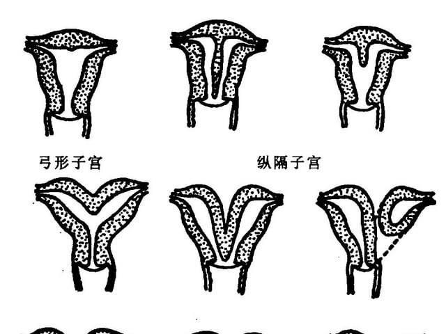 弓形子宫凹陷11毫米属于严重情况