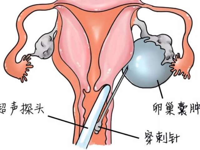 囊肿穿刺手术疼痛感不强烈