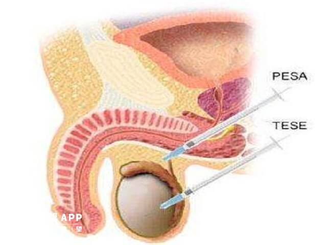 睾丸穿刺取精做二代试管的成功率比较高