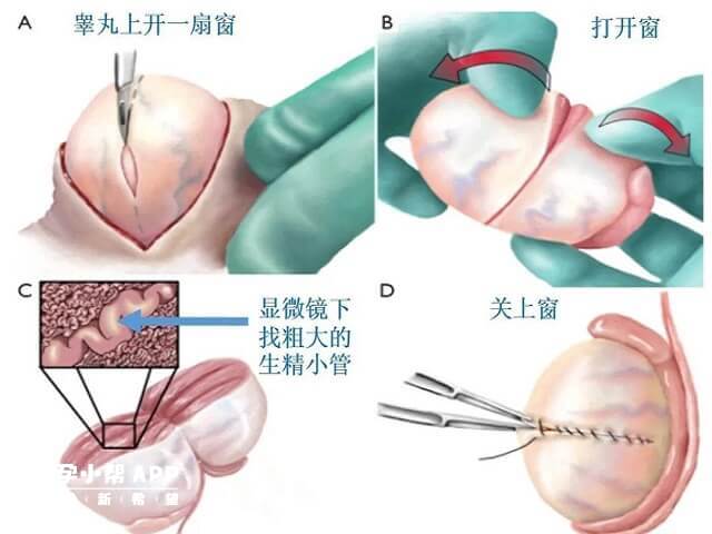 睾丸穿刺取精手术过程