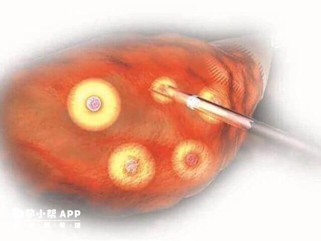取卵手术