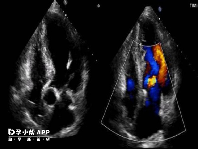 彩超可以检查患者心脏