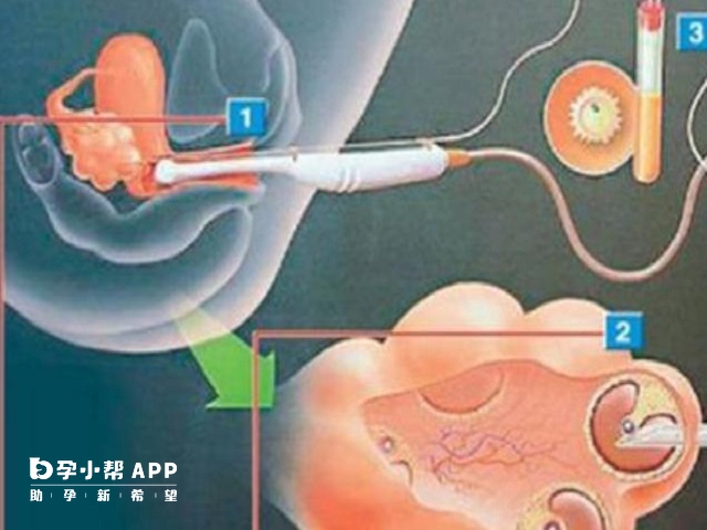 取卵手术的过程
