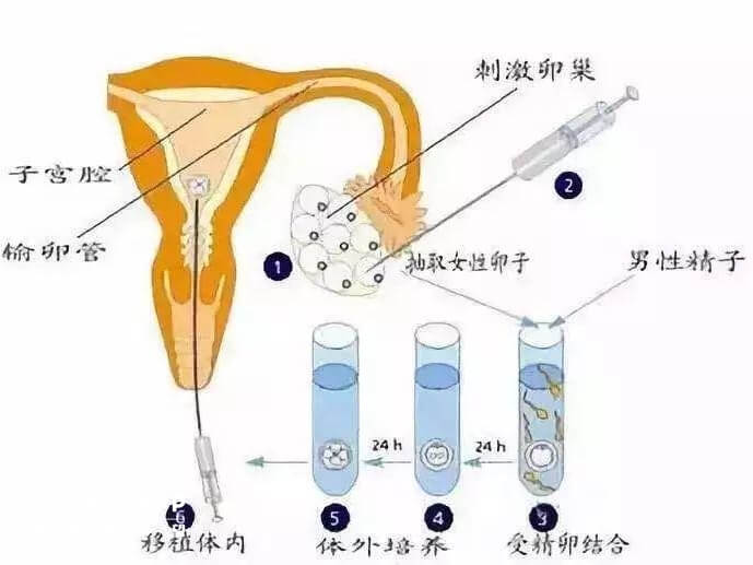 一代试管婴儿