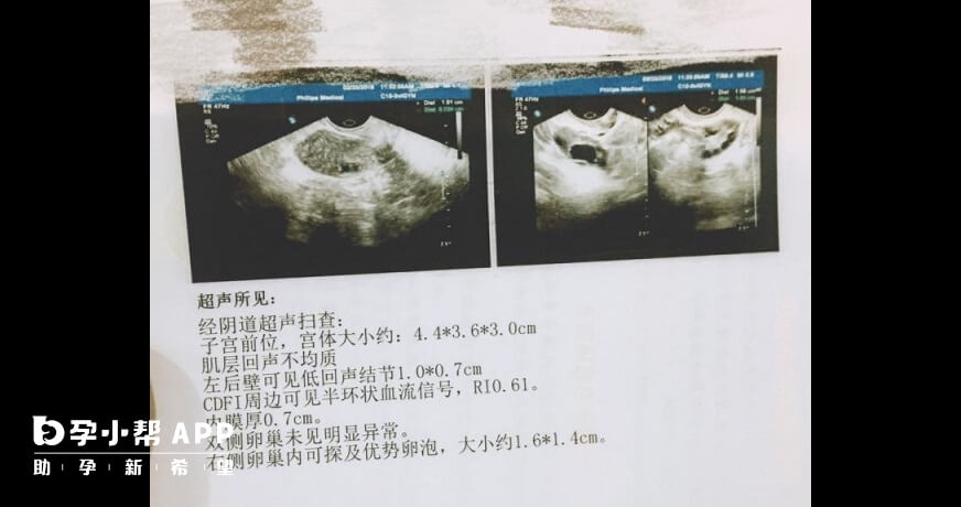 B超卵泡监测单