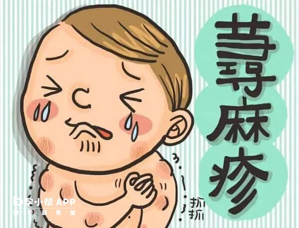 急性荨麻疹打新冠疫苗