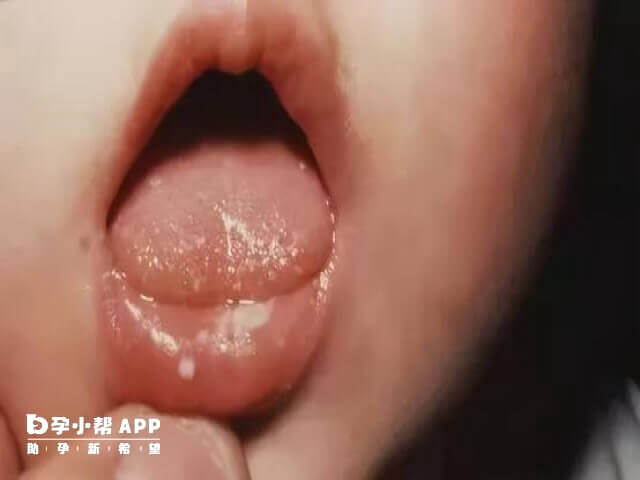 鹅口疮的天敌是益生菌是非常不正确的一种说法