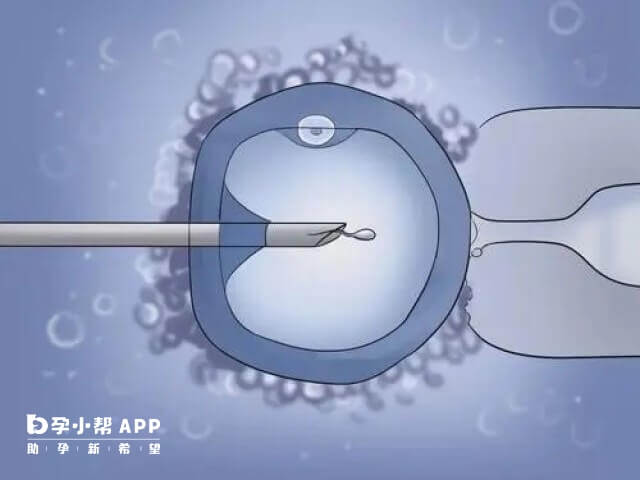 重庆做一次供精人工授精的流程