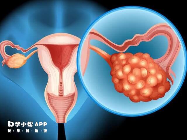 多囊患者会出现不孕