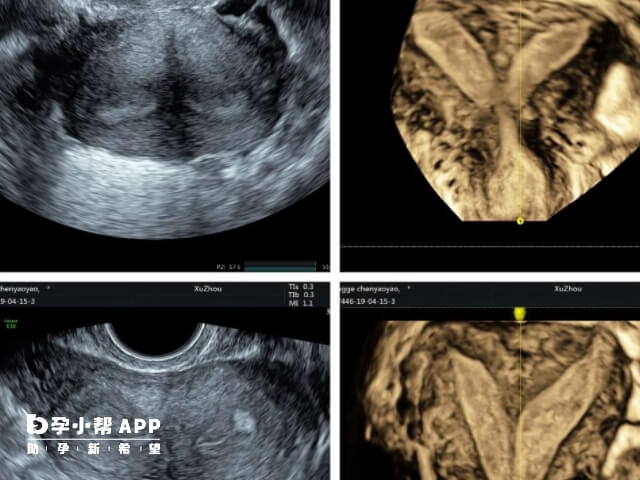 纵隔子宫b超图