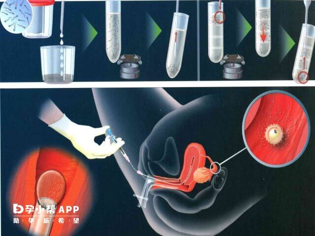 人工授精多次怀不上原因