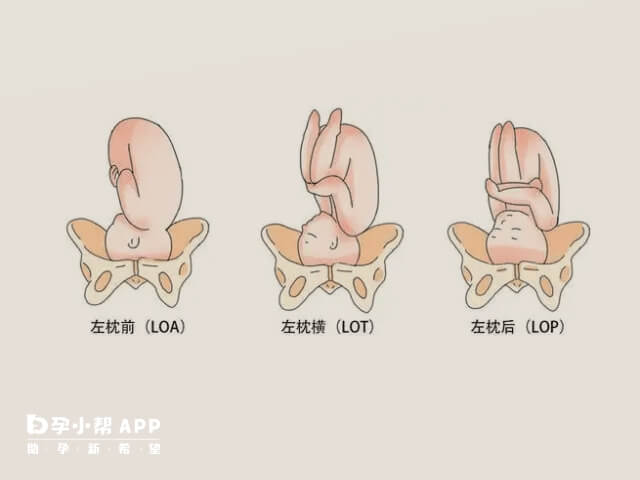 loa胎位在肚子里的样子