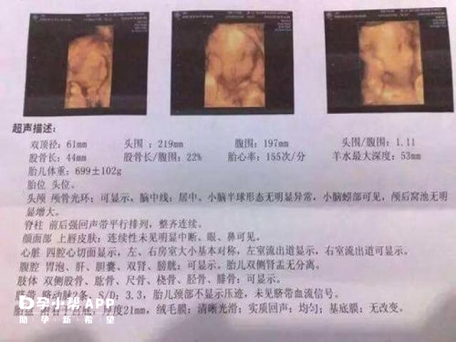 试管双胎35周胎儿双顶径在8.65±0.55cm左右