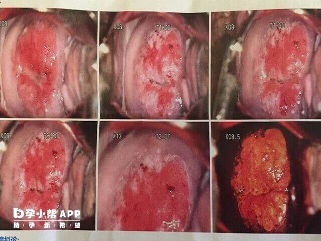 宫颈低度病变不可直接用试管技术助孕