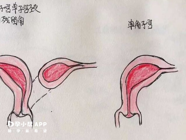 单角子宫试管成功率高