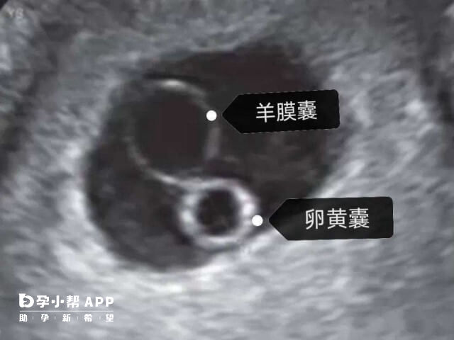 试管B超见卵黄囊不一定成功怀孕