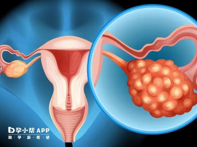 卵巢一侧10个卵泡不算多囊