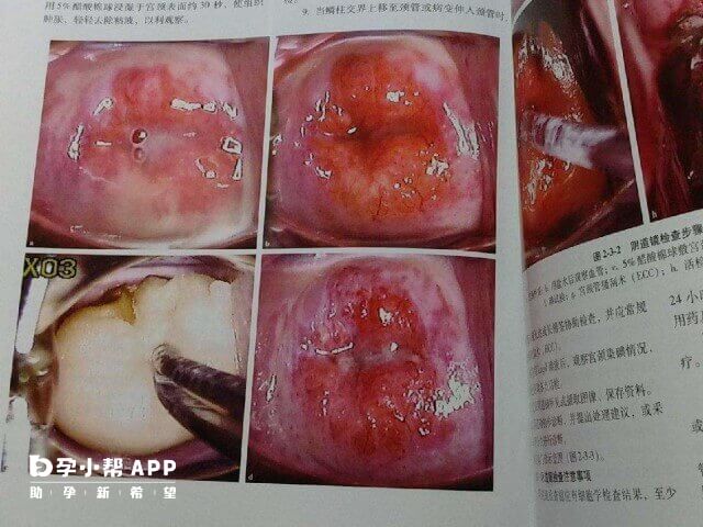 宫颈低度鳞状病变不可以做试管