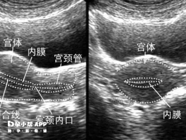 子宫厚度正常厚度8值12mm之间