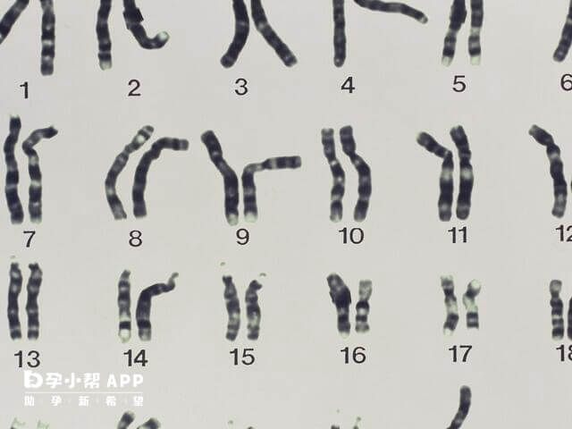 特纳综合症女孩智力并不一定高于常人