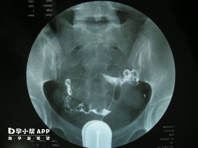 多囊卵巢促排6次没有怀孕需做造影