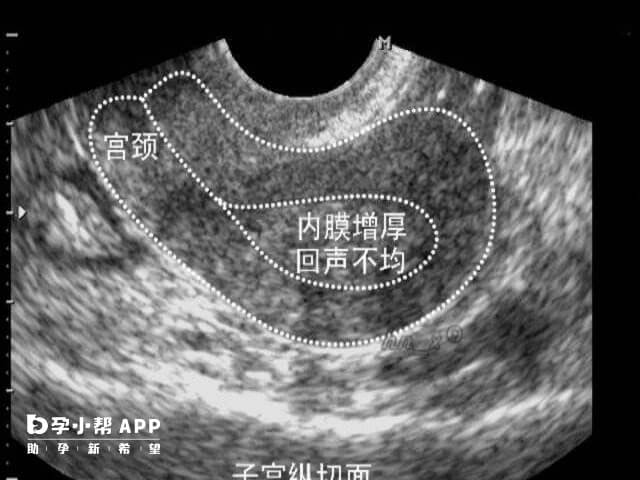 内膜超过12mm能进行移植手术