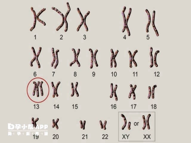 胎儿13三体是精子有问题