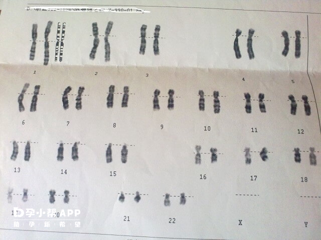 无创显示胎儿7号染色体偏多翻盘几率大
