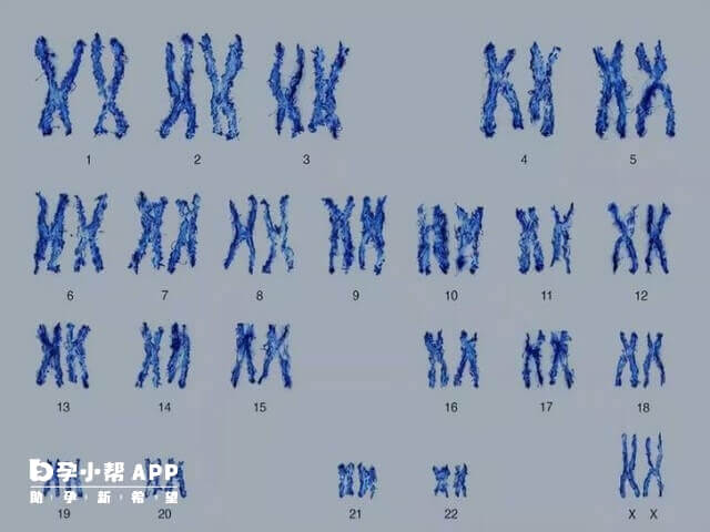 14号染色体偏多代表胎儿发育存在障碍